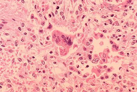 Los Angeles Child Dies from Rare Measles Complication Years Later