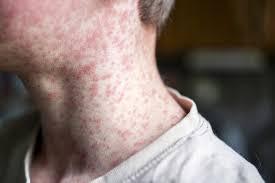 Texas measles outbreak: 136 cases reported, majority tied to federal detention facilities