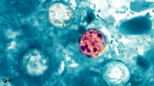 CDC Reports Cyclospora Outbreak Affecting 145 People Across 17 States, Including Texas