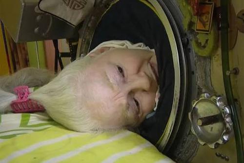 Martha Lillard, Last U.S. Polio Patient Using Iron Lung, Passes Away at 78