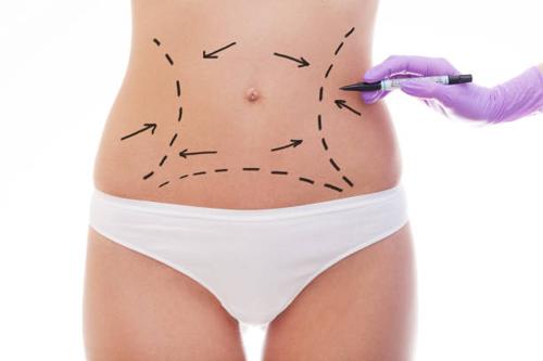 Liposuction Results: When Will You See the Final Outcome?