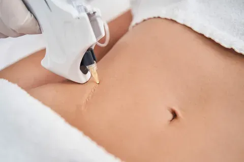Laser Scar Removal in Riyadh: Exploring Advanced Dermatology Approaches